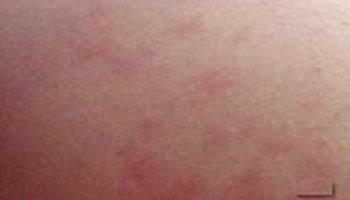 介绍中医中荨麻疹称为"发风丹"风团,荨麻疹是一种比较常见的皮肤过敏