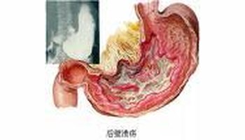良性胃溃疡四周胃壁各层均有水肿,炎性细胞浸润和纤维组织