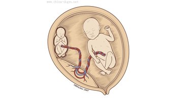 双胎输血综合征