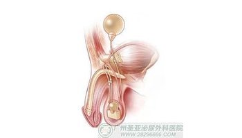 阴茎假体植入术