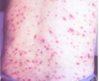 结节性梅毒疹多发生于感染后3-4年内,损害好发于头部,肩部,背部及四肢
