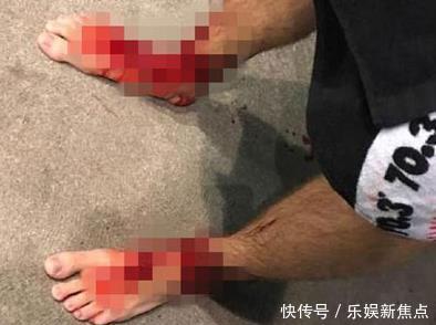 男子下海泡脚解乏，上岸后发现双脚上全是洞，原因让人惊讶不已