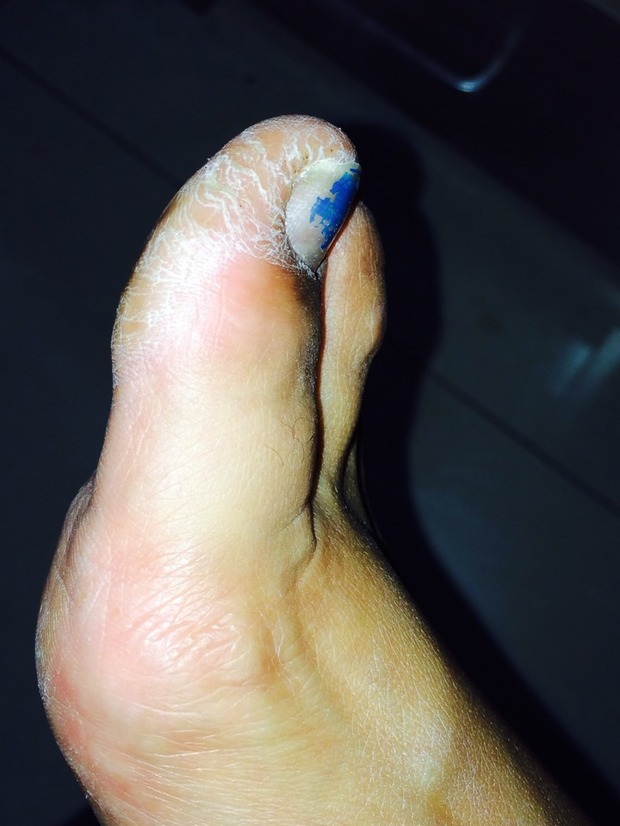 补充上个问题"夏季穿凉鞋脚趾头很干还会裂口是什么情况",有照片