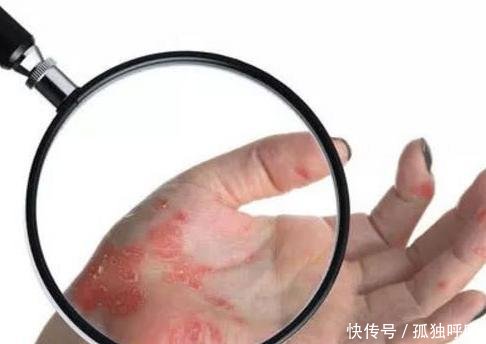 艾滋病的早期症状,一旦出现这些症状,一定要注