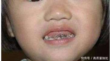 女儿没吃过糖,却一口黑烂牙,到医院后牙医狠狠