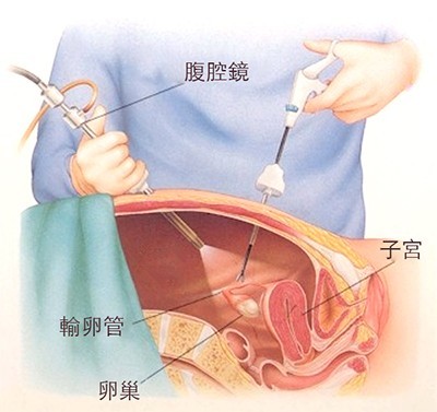 腹腔镜下卵巢打孔术 该方法是克罗米芬抵抗的多囊卵巢综合征患者的