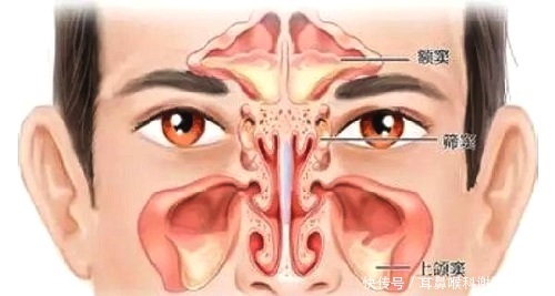 慢性化脓性鼻窦炎如何预防?