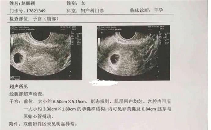 赵丽颖被传已怀孕数月,并且有B超单为证,但网