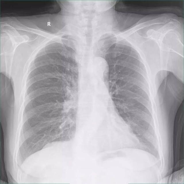 胸片上怎么区分胸膜增厚和胸腔积液?