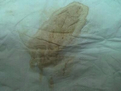 为什么我每次来月经的经血颜色很淡,常伴有腹痛,头疼