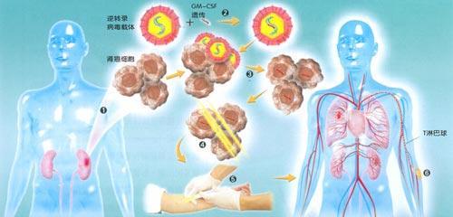 概述 所谓基因疗法,利用健康基因来填补或替代某些缺失或病变的基因