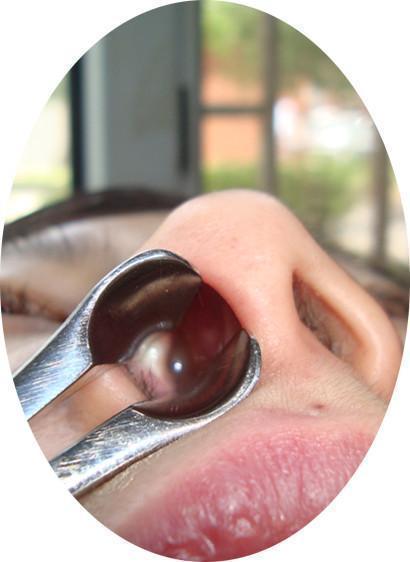 崔付军: 鼻塞吃抗过敏药无效 查查鼻息肉