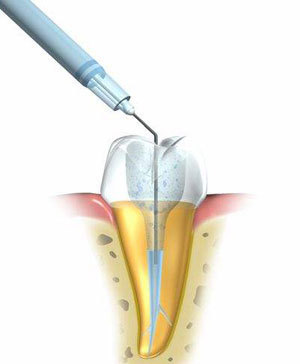 郑州牙齿根管治疗多少钱?牙齿龋坏非常严重,医
