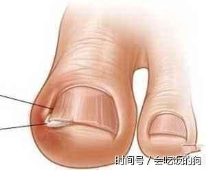 脚趾甲往肉里长又疼又痒? 教你一招自己轻松解决! - 平淡无奇 - 平淡无奇博客 脚趾甲往肉里长又疼又痒? 教你一招自己轻松解决! - 平淡无奇 - 平淡无奇博客