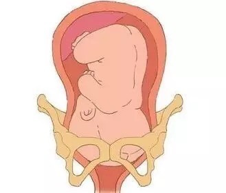 孕期(产后)有一种痛,叫做:耻骨联合分离症