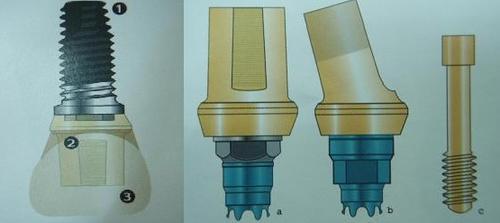 我想做个种植牙,上海哪里做种植牙的效果最好