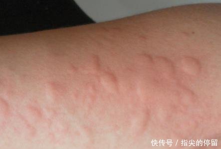 荨麻疹止痒小妙招有哪些 这六个止痒方法帮你