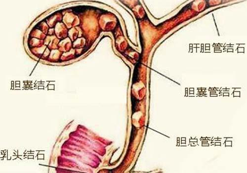 胆囊在哪边_ct增强胆囊壁高亮_胆囊切除后注意