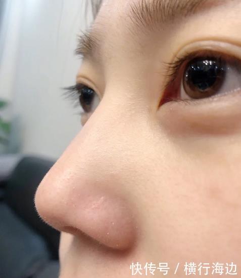 皮肤差有哪几种表现?肤色暗黄黑头多的人很多,很影响“颜值” 明升88注册