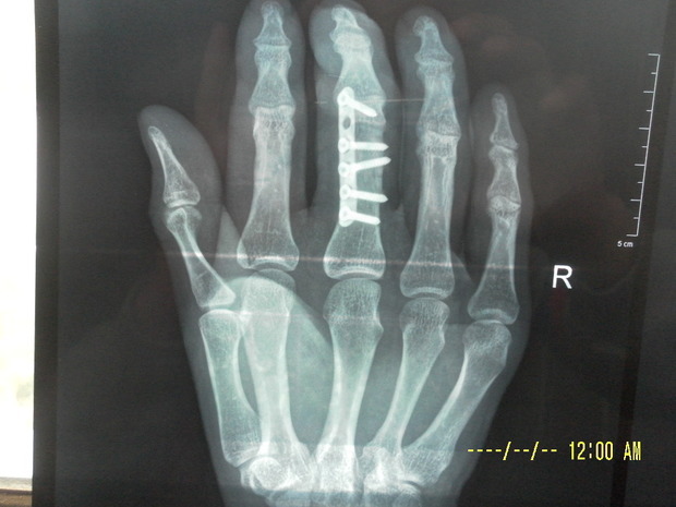 右手中指骨折了钢板内固定超过关节现在活动有