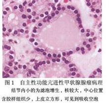 引起甲亢的原出并非由于某些甲状腺刺激因子,而是滤泡细胞增生所形成