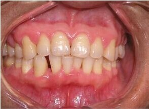 牙龈炎和牙周炎图片?