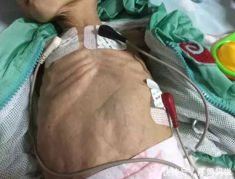 1岁小婴儿每天无原因腹泻上百次,消瘦得不成