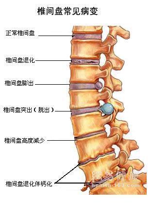 椎问盘轻度膨出,硬膜受压,椎体缘骨质增生,小关