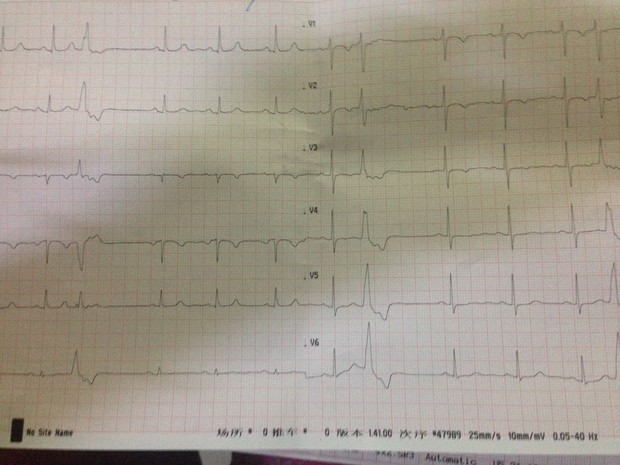 大家帮我看下这个心电图,大夫让住院做心脏照
