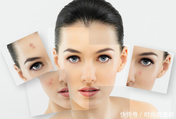 长痘痘了怎么消除,痘痘怎么快速消除