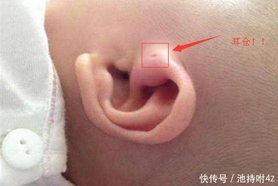 宝宝耳朵边有个洞竟然被医生说是祸?不懂真