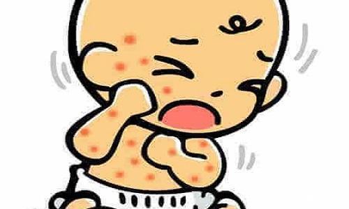 冬天小孩会经常出湿疹的吗?小儿湿疹预防措施