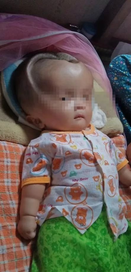 一3个月大婴儿天生头部畸形, 贫穷父母称去医