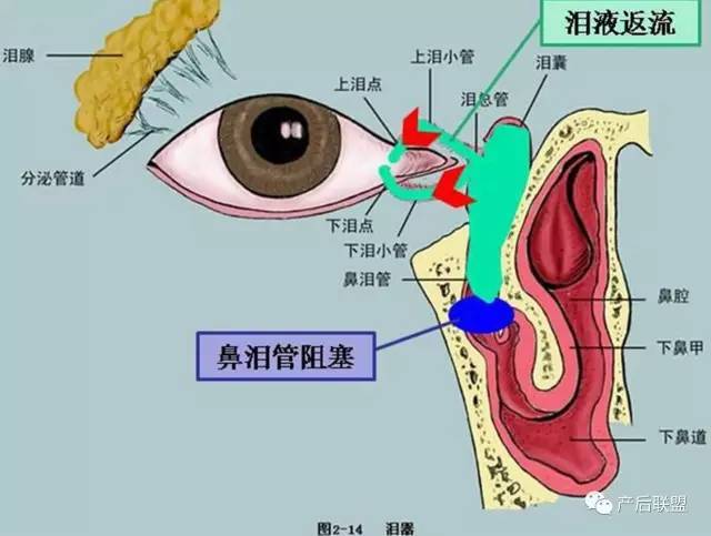 轻微的堵塞可以通过按摩护理,严重的再考虑去医院通鼻泪管.