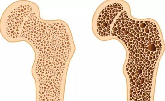 防治骨质疏松应该怎么做才好?日常生活坚持五宜五不宜很关键!