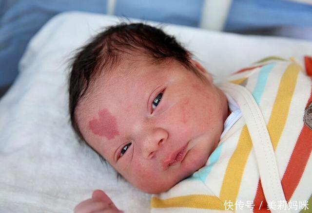 出生宝宝屁股有青色胎记莫着急,随年龄增长会