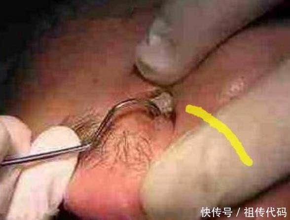 男子鼻子里长了20年的异物, 近来时痛时痒, 医生拔出后却看
