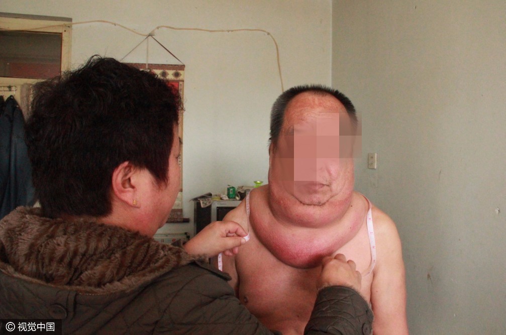 【转】北京时间 53岁男子得怪病 脖子周长97厘米起床困难易摔倒 - 妙康居士 - 妙康居士~晴樵雪读的博客 【转】北京时间 53岁男子得怪病 脖子周长97厘米起床困难易摔倒 - 妙康居士 - 妙康居士~晴樵雪读的博客