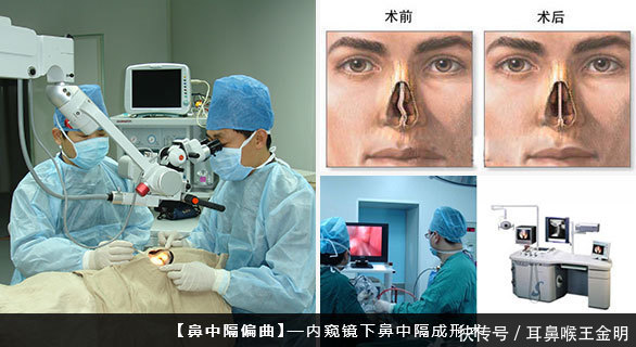 做鼻中隔偏曲手术会不会引起空鼻症?