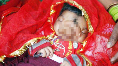 涨健识 近亲通婚女童脸上长象鼻