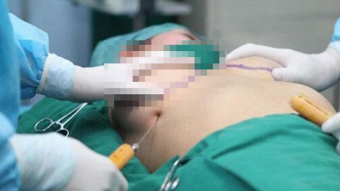涨健识 女子不堪巨乳折磨竟割胸