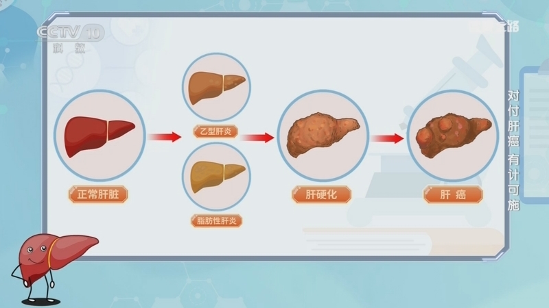 健康之路 《健康之路》 20241028 对付肝癌 有计可施
