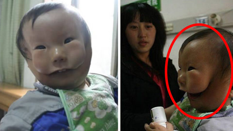 涨健识 心疼！男孩天生戴有面具
