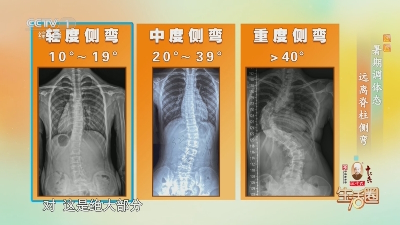 生活圈 《生活圈》 20260628 暑期调体态 远离脊柱侧弯