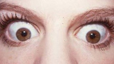 健康诊聊室 健康诊聊室之激光手术能否矫正眼球突出