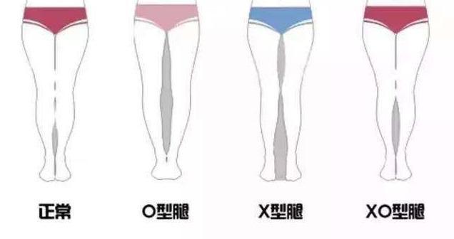 o/x/xo型腿,你是哪種?附矯正動作