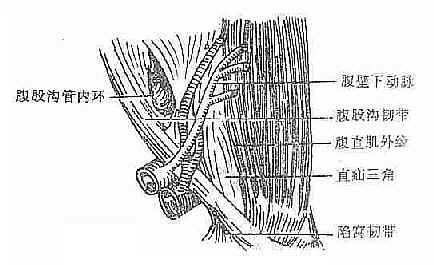 基本概述 腹股溝直疝係指從腹壁下動脈內側, 經腹股溝三角區突出的腹