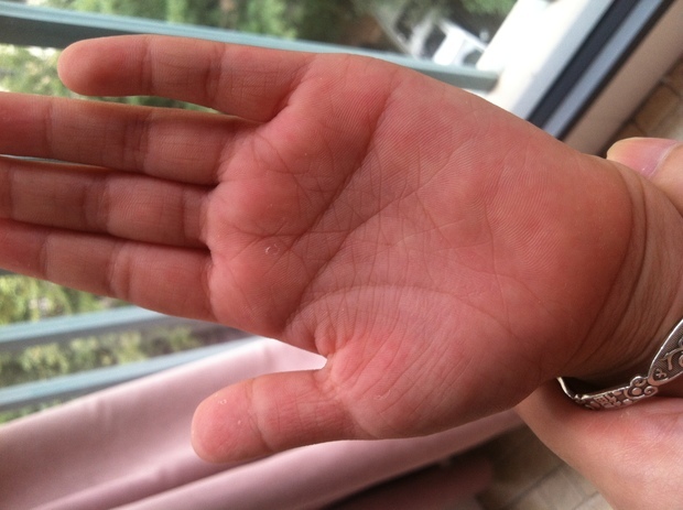 请问左手上的是悉尼线吗?
