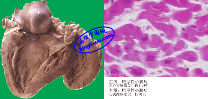 室间隔不对称性肥厚,心室腔变小,心腔充盈受阻,心肌细胞异常肥大为