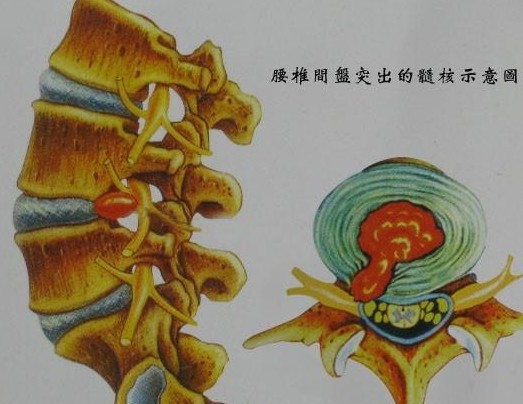 腰間盤相當於一個微動關節,是由透明軟骨板,纖維環和髓核組成